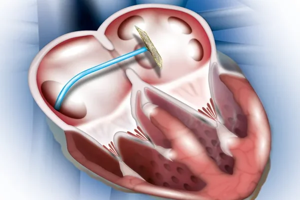 Device Closure of ASD
