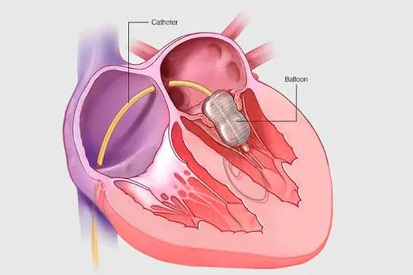 Percutaneous Balloon Mitral Valvuloplasty